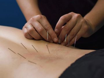 Acupuncture, Dry Needling