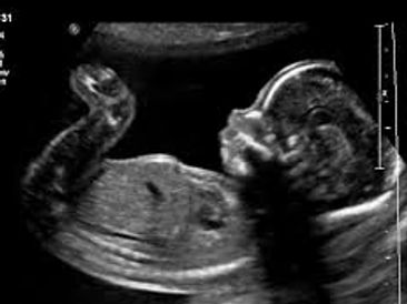 Baby Ultrasound
