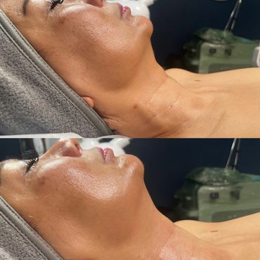 Before and after skincare treatment showing enhanced skin glow and smoothness.