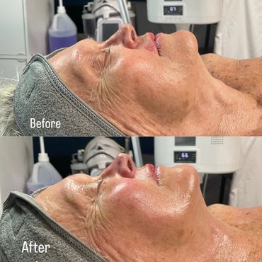 Side-by-side before and after facial skin treatment showing improved skin texture and glow.
