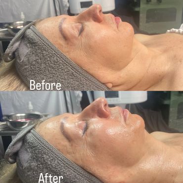 Side-by-side before and after facial treatment showing improved skin texture and glow.