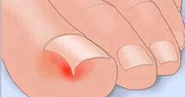 L'ongle incarné est une des pires douleurs que l'on puisse ressentir aux pieds.