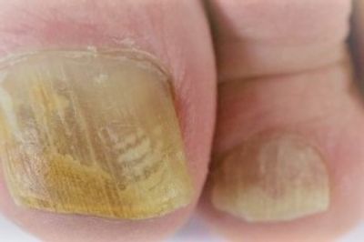 Toe nail with fungal infection 