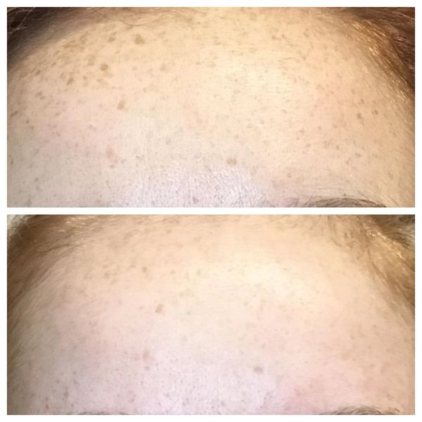 The results  from one photofacial to remove freckles.