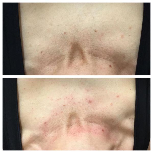 Before and immediately after a photofacial on the chest. 