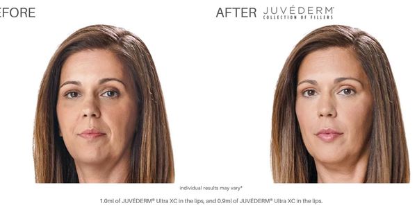 juvederm cheek enhancement lip enhancement rxcosmetics botox dysport wrinkles antiaging skin care