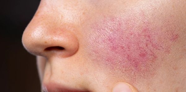 Rosacea acne melasma