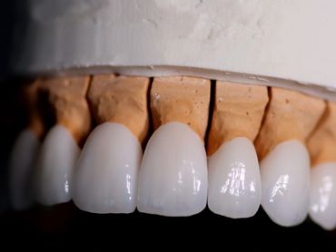 Esthetic Dental Implants