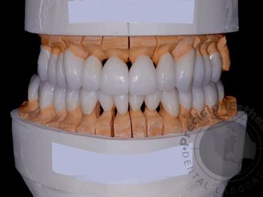 Dental Crowns in Florida Laboratory