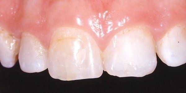 e.max Press Dental Case