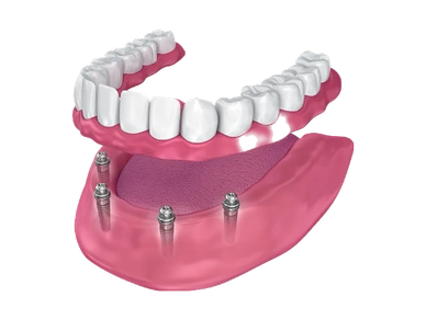 Dental Implants by your full service laboratory