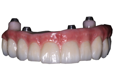 Highly Esthetic Ceramic Restorations from Precision Esthetics Dental Laboratory.