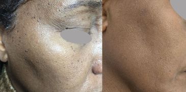 Skin Tags & Facial Fibromas Removal