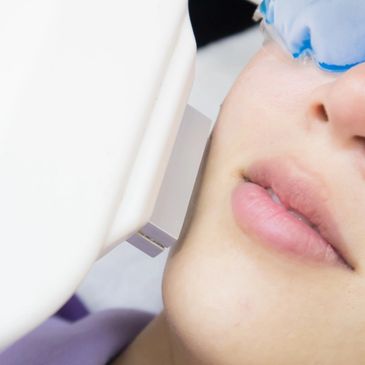 Intensive Pulse Light (IPL) Treatment