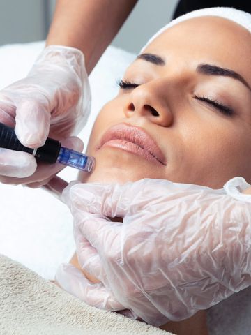 Image of client getting a micro needling treatment