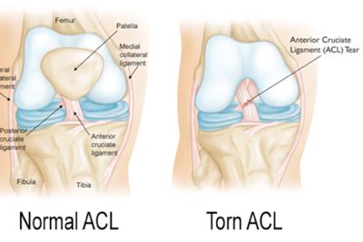 torn ACL