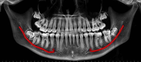 CBCT derived Grey-scale Panoramic view (OPG) of the Jaws