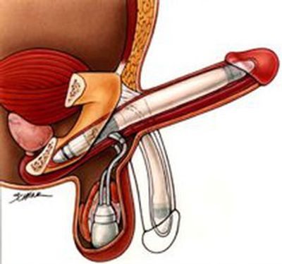 تاريخ زراعة دعامات القضيب
علاج التسريب الوريدي
التسرب الوريدي
علاج عدم الانتصاب
زراعة الدعامات في الاردن