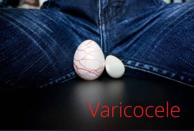 علاج دوالي الخصية باحدث الطرق العلمية باستخدام الميكروسكوب الجراحي أفضل طبيب لعلاج الضعف الجنسي