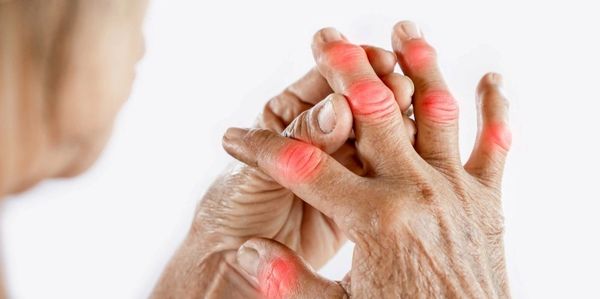 Arthritis