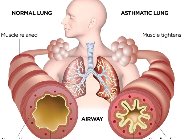 Asthma