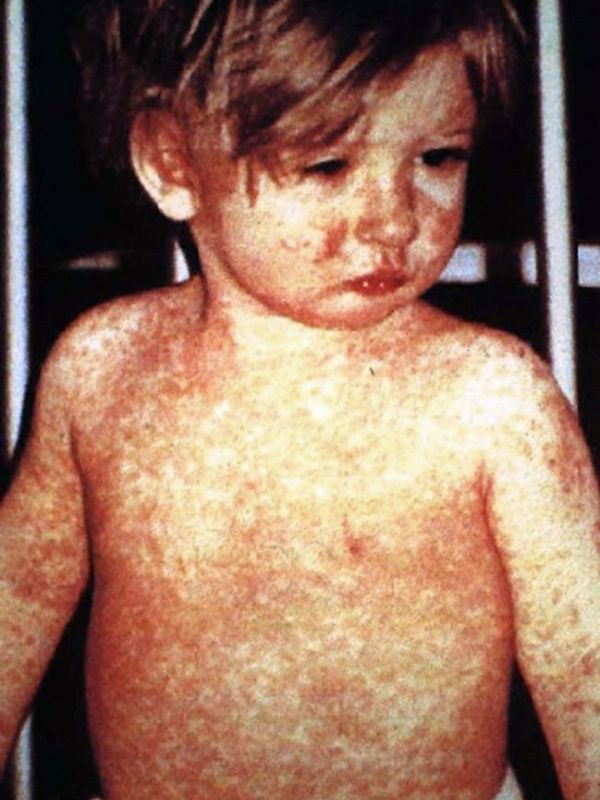 Measles