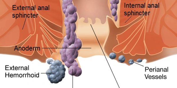 Hemorrhoids