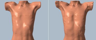 Comparison scans pectus excavatum