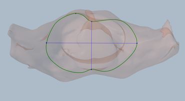 Transverse view of Pectus Excavatum