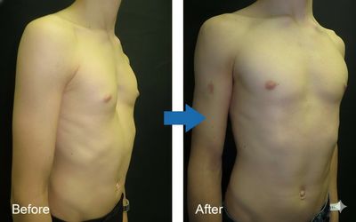 Before and after photos showing chest correction surgery results.