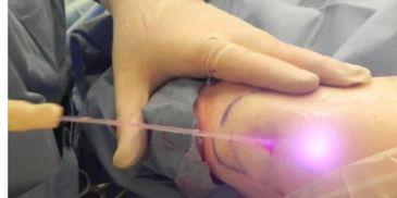 Lazer treatment for burning fat and shrinking skin