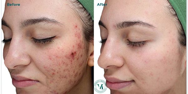 VI Peel acne treatment.