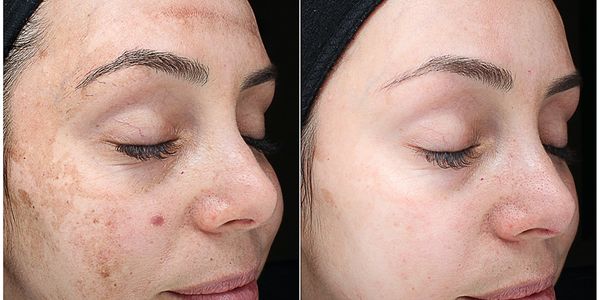 VI Chemical Peel treatment results.