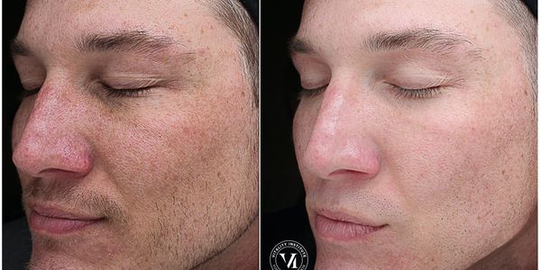 VI Chemical Peel Precision Plus results.