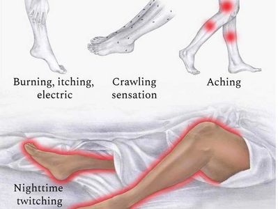 Illustration of leg symptoms: burning, itching, crawling sensation, aching, and nighttime twitching.