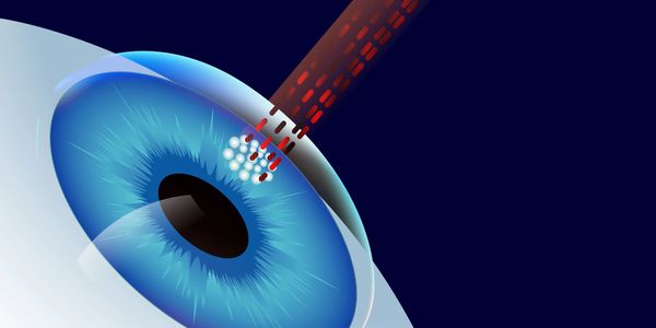 Illustration of laser eye surgery correcting vision.