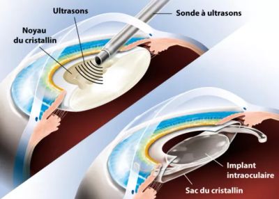 Illustration of ultrasound cataract surgery with intraocular lens implant.