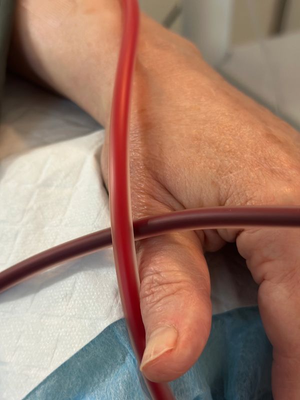 Extracorporeal Blood Oxygenation and Ozonation (EBOO) Therapy Lake Oswego at Evergreen Factor 97035.