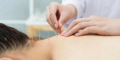 acupuncture.