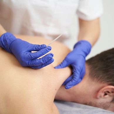 Acupuncture treatment on a person's shoulder.