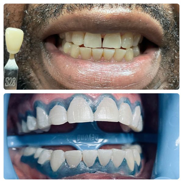 Before and after a professional teeth whitening session