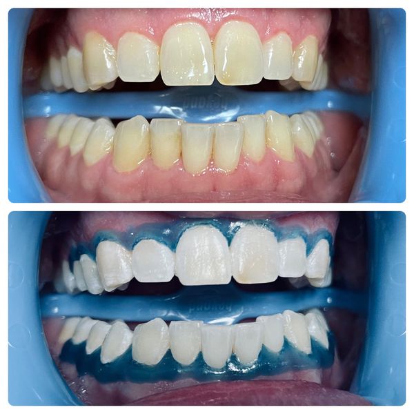 Before and after a professional teeth whitening session