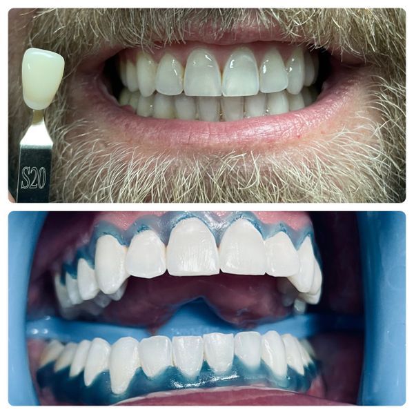 Before and after a professional teeth whitening session