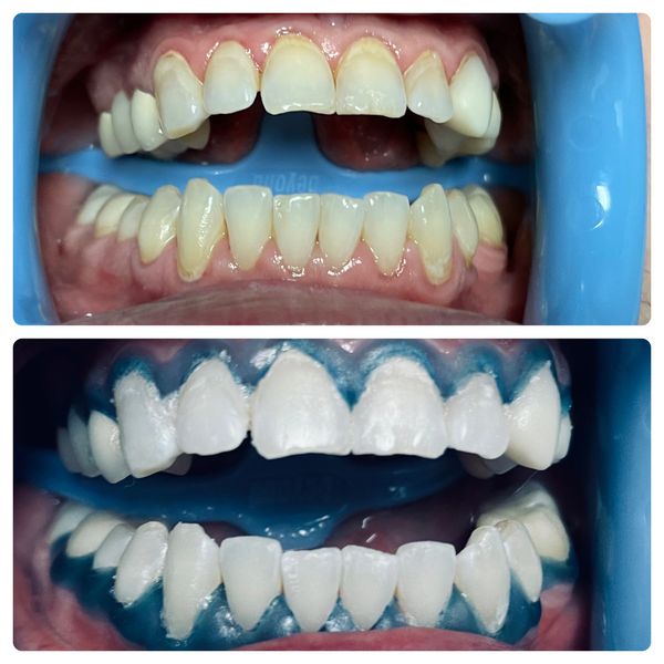 Before and after a professional teeth whitening session