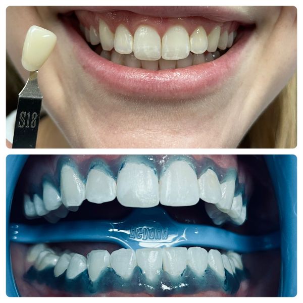 Before and after a professional teeth whitening session