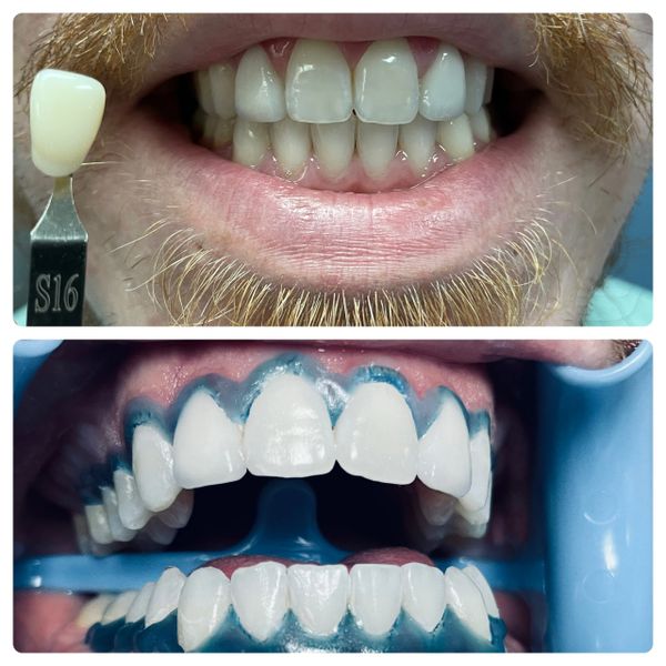 Before and after a professional teeth whitening session