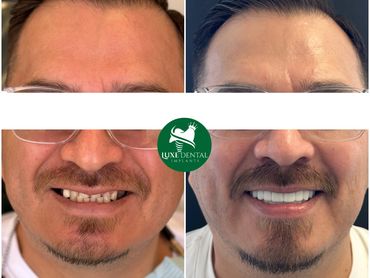 Before After Smile make over