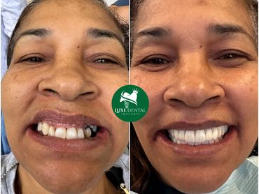 Before After Smile make over