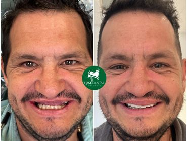 Before After Smile make over