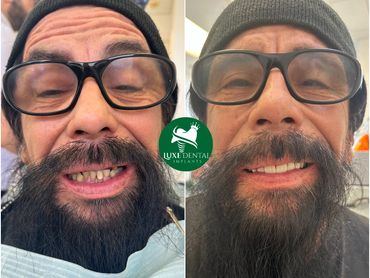 Before After Smile makeover